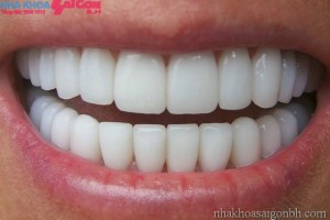 Phục hình răng khôi phục vẻ hoàn mỹ cho răng miệng 
