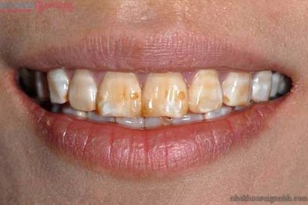 rang nhiem tetracycline10 450x300 Các trường hợp cần trám răng?