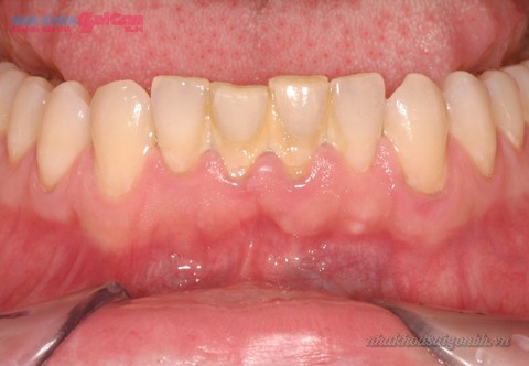 Mảng cao răng gây mất thẩm mỹ