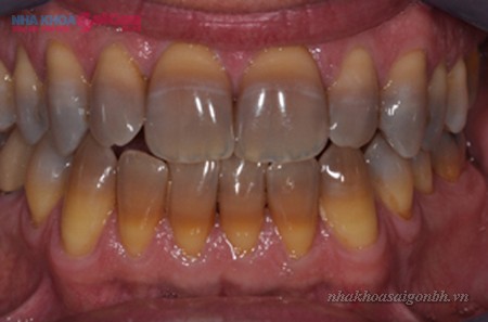 răng bị nhiễm màu tetra nặng không thể tẩy trắng