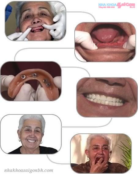 Trồng răng implant cho người cao tuổi 