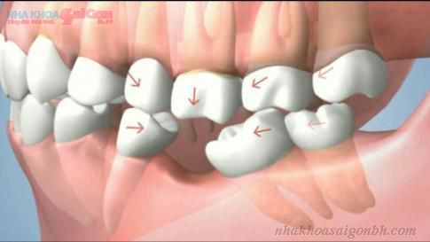 Hậu quả của việc mất răng không được cấy ghép implant 