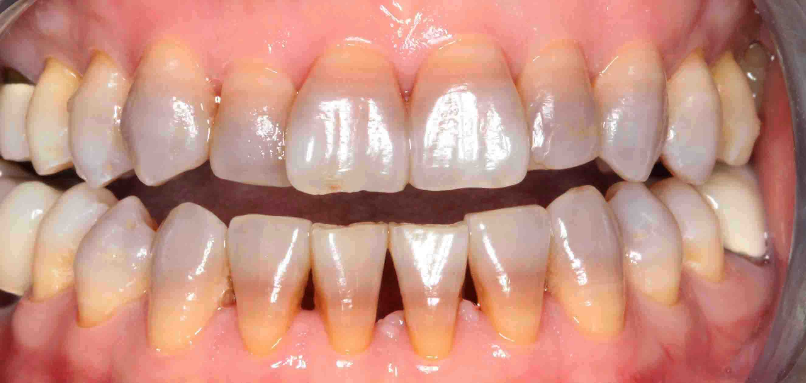 răng bị nhiễm màu tetra nặng không thẻ tẩy trắng