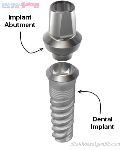 Tiêu chí để lựa chọn implant khi cấy ghép 