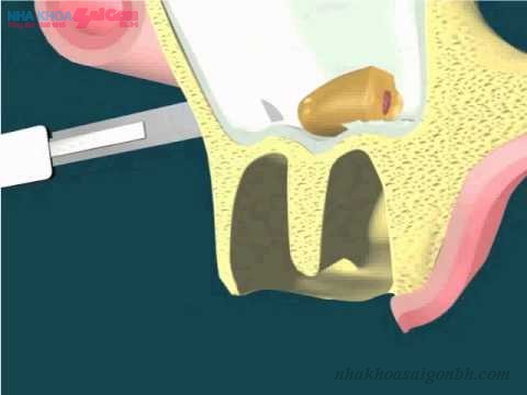 Nâng xoang hàm khi cấy ghép implant 
