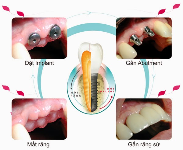 Hỏi đáp chi tiết về dịch vụ cấy ghép răng sứ implant nha khoa