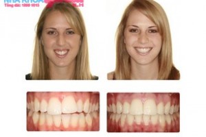 trước và sau khi phẫu thuật chỉnh nha
