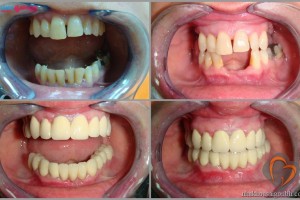 phục hình răng cố dịnh