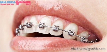 8 điều lưu ý khi niềng răng