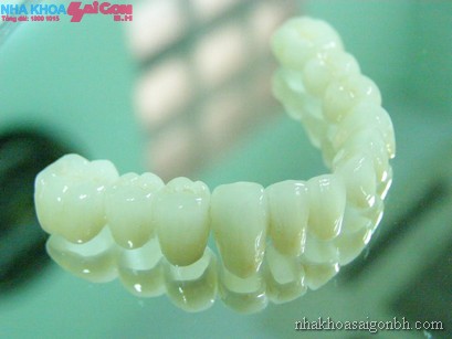 Mão răng – phương pháp phục hình cố định