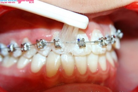Cách chải răng khi mang niêng
