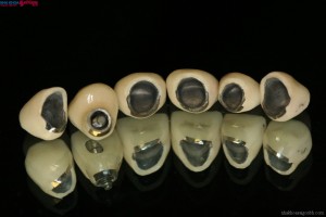 răng giả sứ - kim loại