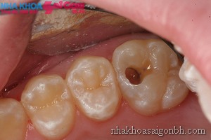 Sâu răng nguyên nhân gây viêm tủy răng