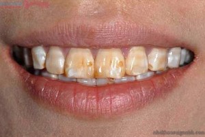 Răng bị nhiễm tetracycline