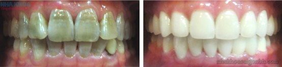 Trước và sau khi phục hình răng bị nhiễm Tetracyclime