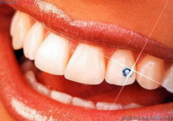 Đính kim cương lên răng giúp cho bạn có một nụ cười tỏa sáng