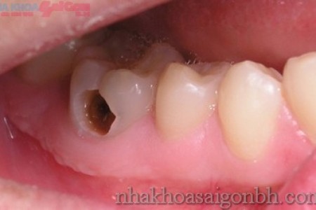 Trám răng  cho trường hợp sâu răng