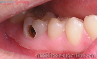 Trám răng cho trường hợp sâu răng