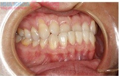 Có nên nhổ răng khi chỉnh nha không?