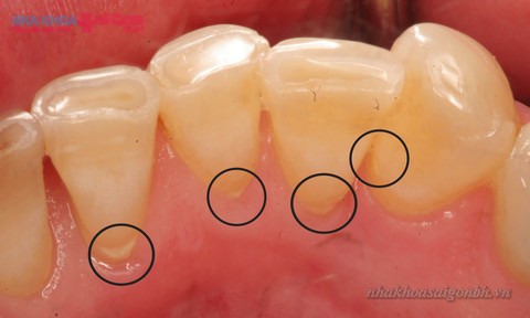 Các vi khuẩn ẩn trong cao răng có thể gây các bệnh răng miệng