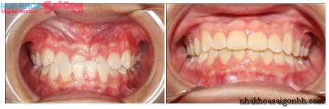 Trước và sau khi niềng răng móm