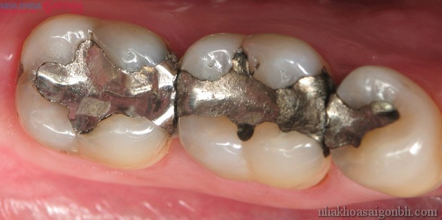 Trám răng bằng Amalgam bền và rẻ