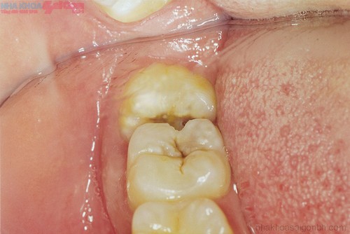 Vì sao hầu hết răng khôn thường phải nhổ bỏ?