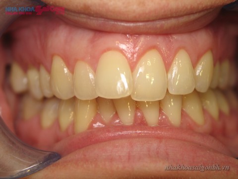 răng bị nhiễm màu do thực phẩm