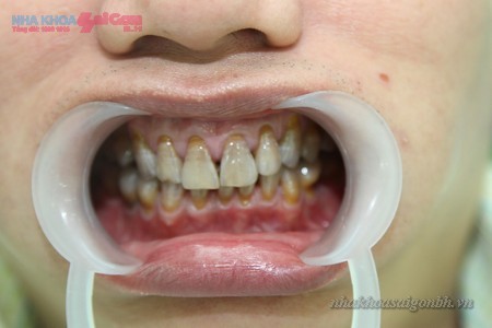 răng bị nhiễm màu tetra nặng không thể tẩy trắng