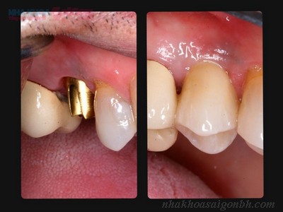 răng implant 