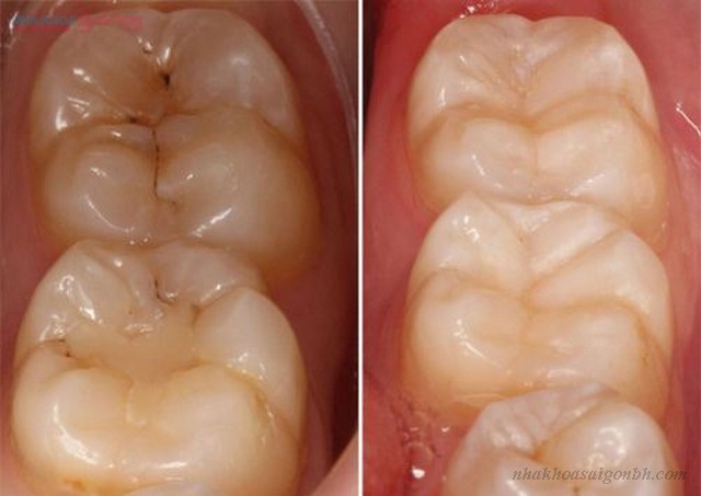 Trám răng giúp ngăn ngừa sâu răng