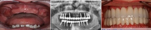 Cấy ghép implant cho trường hợp mất răng toàn hàm 