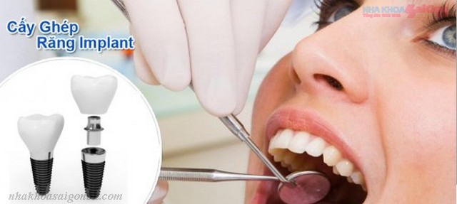 Cấy ghép răng implant tồn tại được bao lâu?