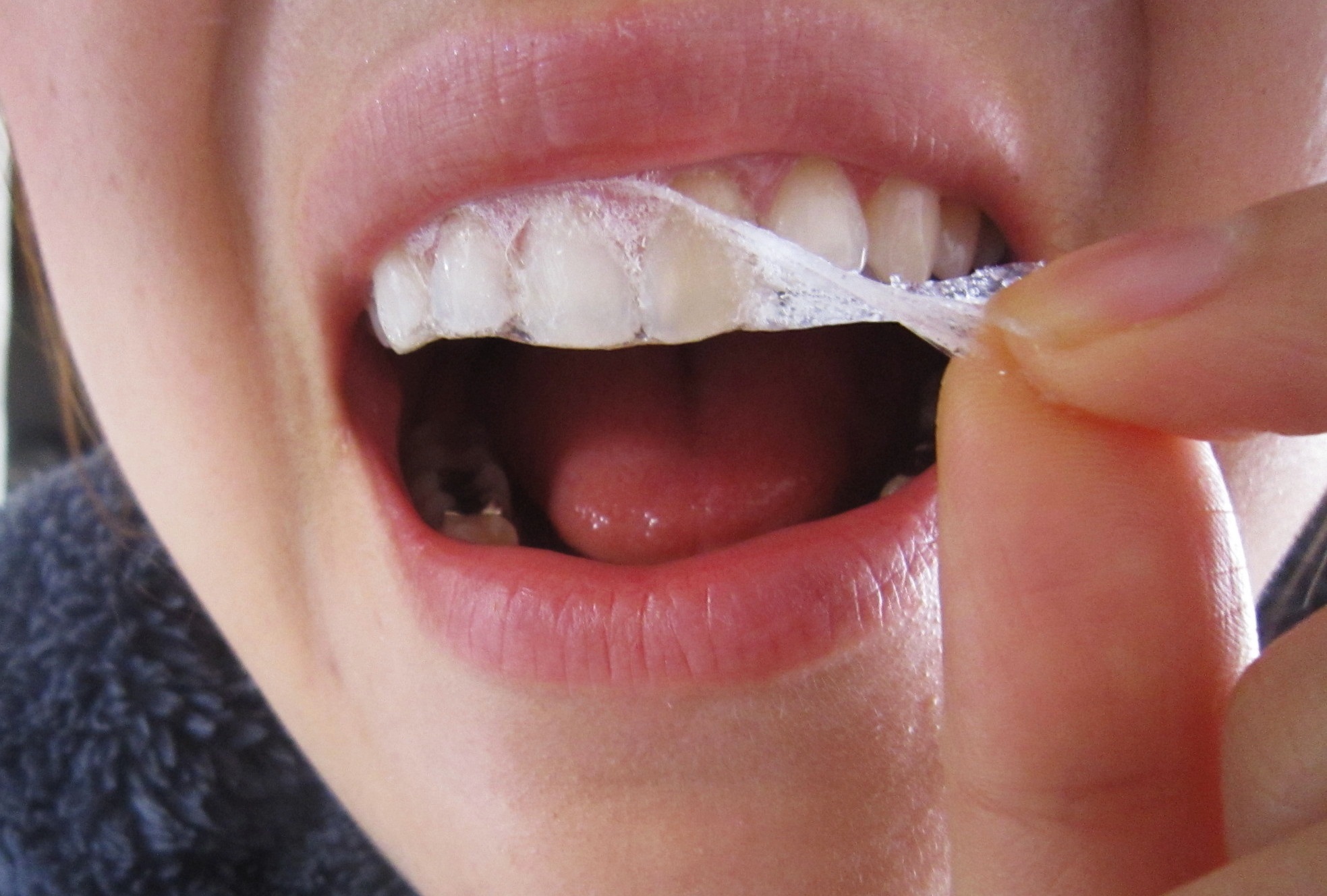 Sử dụng miếng dán tẩy trắng răng