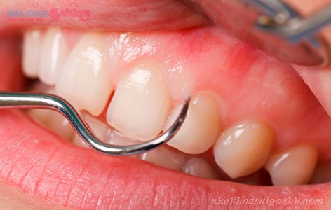 Nguyên nhân gây mất răng cần cấy ghép implant