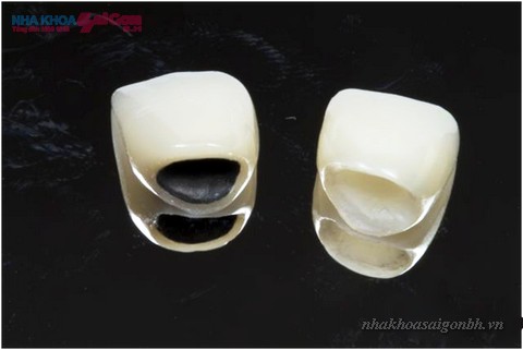 bọc răng sứ thẩm mỹ bằng titan