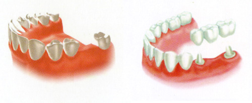 Trồng răng implant khác với trồng răng sứ ở điểm nào?