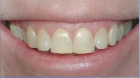 các mảng bám làm răng bị vàng ố