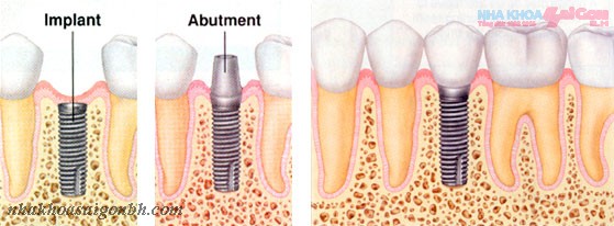 Trồng răng bằng phương pháp implant có an toàn không?