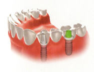 Trồng răng implant khác với trồng răng sứ ở điểm nào? 