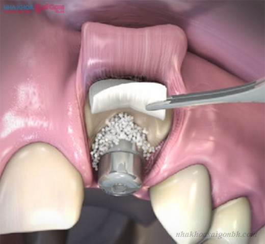 Nâng xoang hàm khi cấy ghép implant