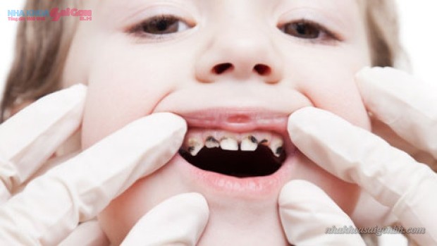 trẻ em trám răng ngăn ngừa sâu răng