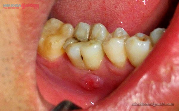 Sâu răng và cách điều trị triệt để