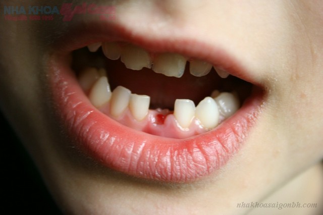 Trẻ em có thể trồng răng implant không? 