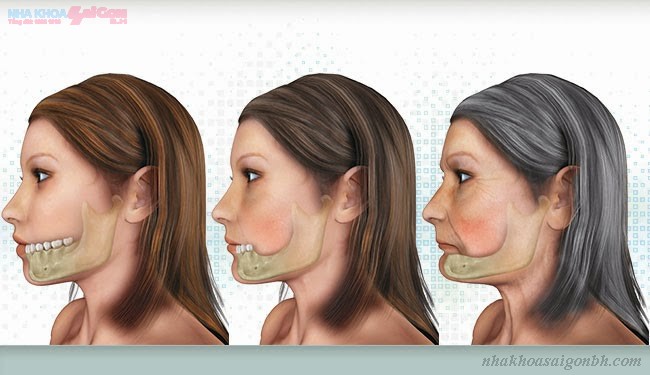 Sau khi cấy ghép implant khuôn mặt thay đổi như thế nào?