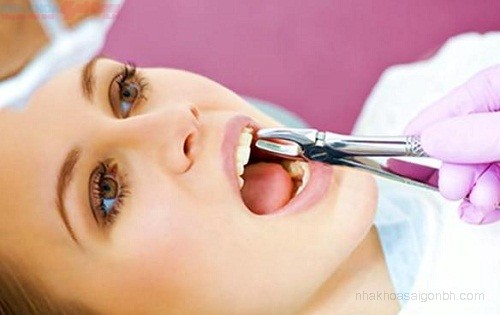 Nhổ răng không đúng lúc có thể nguy hiểm đến tính mạng