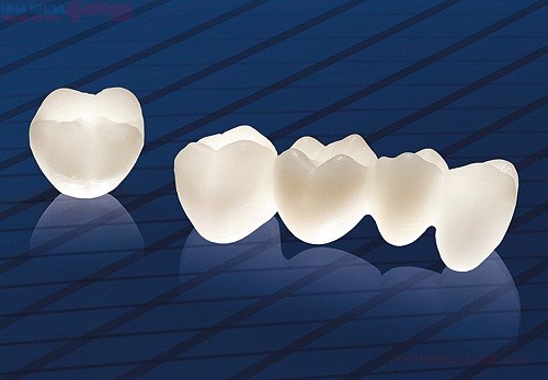 Các loại răng sứ được ưu chuộng hiện nay