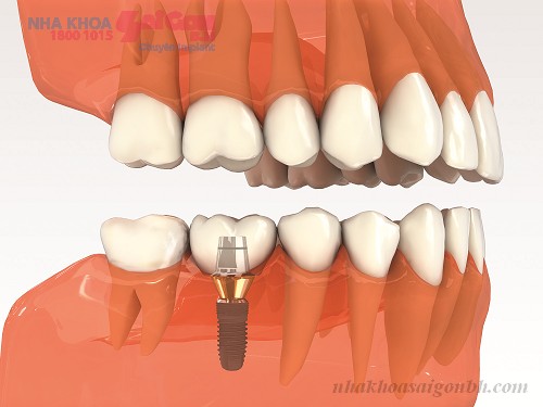 Cấy ghép implant bao nhiêu tiền một răng?