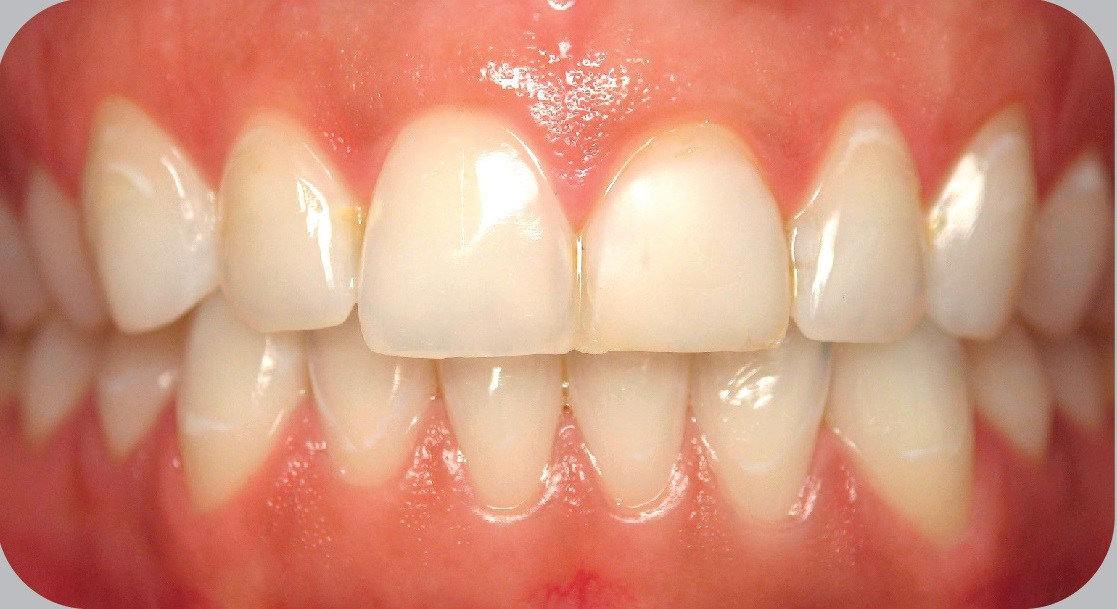 Răng bị vàng ố đang trở nên phổ biến