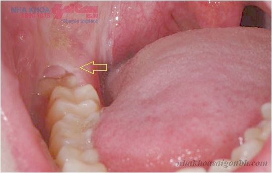 Có nên nhổ răng mọc thấp để cấy ghép implant không?